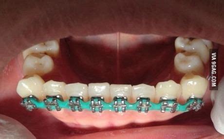 failed braces result|Braces Gone Wrong .